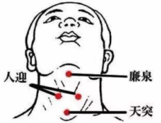 咽炎的拔罐思路