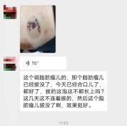 发泡拔罐治疗脂肪瘤案例两个