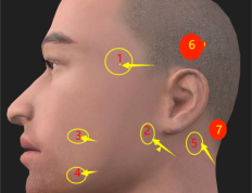 三叉神经疼面瘫，面部问题。处理思路。