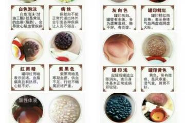 罐印和体液分析